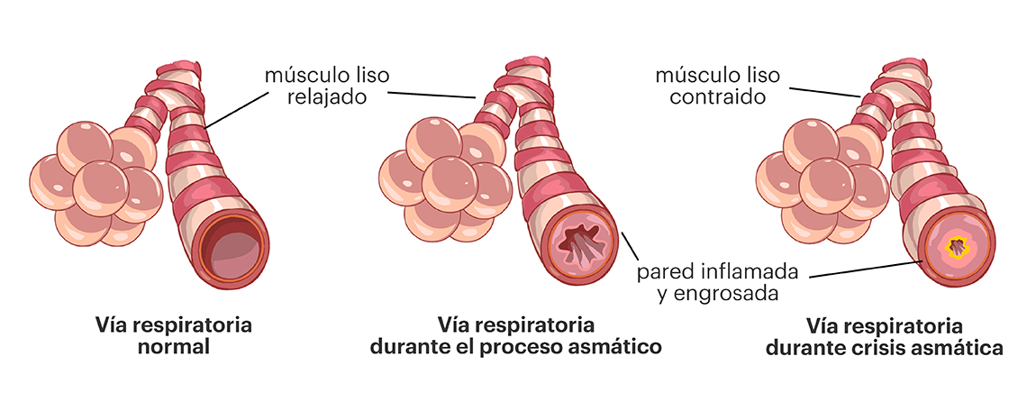 Cambios estructurales por remodelación de la vía respiratoria en el asma